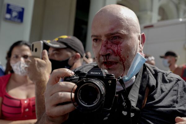Фотограф AP, испанец Рамон Эспиноса, с травмами на лице, освещает демонстрацию против президента Кубы Мигеля Диас-Канеля в Гаване  - Sputnik Абхазия