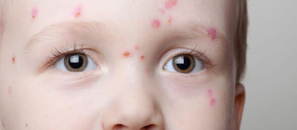 Ветрянка Ветрянка - Sputnik Аҧсны