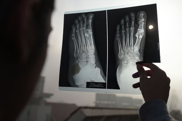 Девушка наблюдает солнечное затмение через рентгеновский снимок ноги в Пакистане.  - Sputnik Абхазия